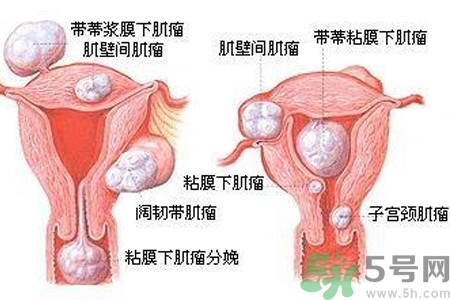 ?子宮移位怎么治療？子宮移位能懷孕嗎？