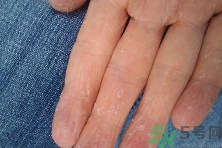 ?手掌脫皮的危害有哪些？如何預防手掌脫皮？