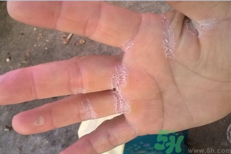 手脫皮是什么原因？手脫皮的治療方法是什么？