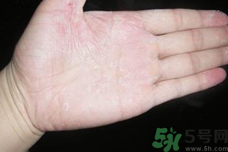 手脫皮是什么原因？手脫皮的治療方法是什么？