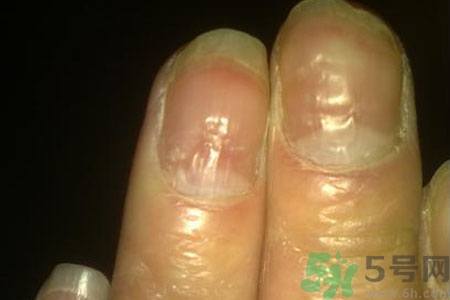 孩子手指甲凹凸不平是什么原因？手指甲凹凸不平的原因是什么？