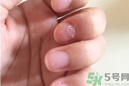 孩子手指甲凹凸不平是什么原因？手指甲凹凸不平的原因是什么？