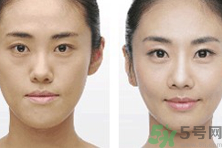 激光縮毛孔多少錢一次？激光縮毛孔一個療程多少錢？