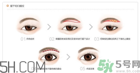 切眉手術后老得快嗎？切眉能保持多久？