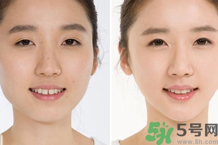 玻尿酸隆鼻的危害有哪些？玻尿酸隆鼻的副作用是什么？