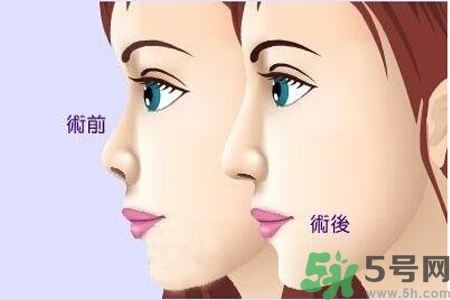 玻尿酸隆鼻的缺點是什么？玻尿酸隆鼻的優點有哪些？