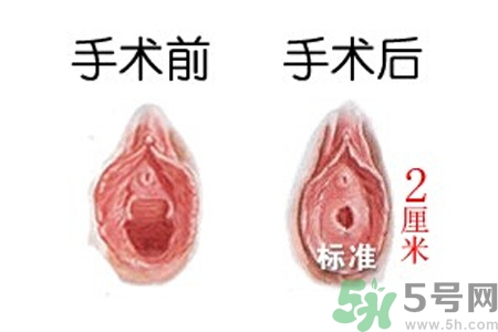 什么人不能做處女膜修補(bǔ)術(shù)？處女膜修補(bǔ)術(shù)會(huì)留疤嗎？