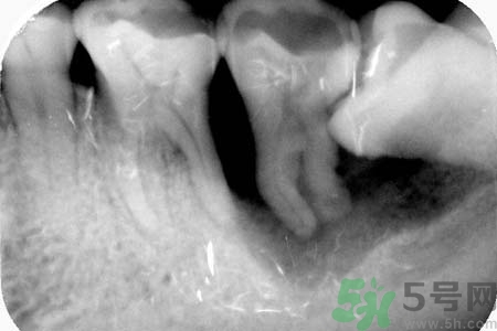 拔智齒一顆多少錢？拔除智齒收費(fèi)多少？