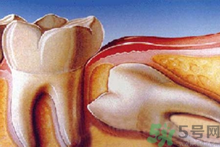 拔智齒一顆多少錢？拔除智齒收費(fèi)多少？