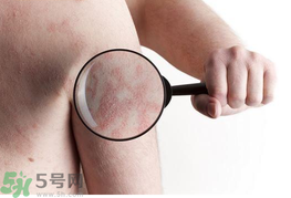 痱子和汗斑的區別 汗斑用什么藥擦最有效