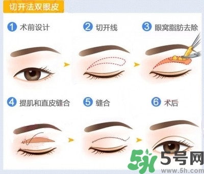 雙眼皮手術哪種最好？割雙眼皮后注意些什么？