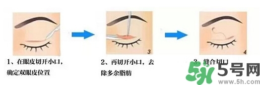 雙眼皮手術哪種最好？割雙眼皮后注意些什么？
