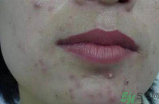 什么樣的痘痘能擠？哪些痘痘不能擠？