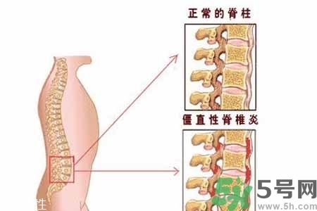 僵直性脊椎炎的癥狀有哪些？怎樣預防僵直性脊椎炎？