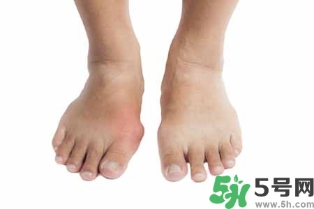 引發痛風的原因是什么？痛風病人飲食需注意什么好？