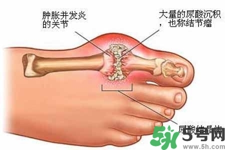 引發痛風的原因是什么？痛風病人飲食需注意什么好？