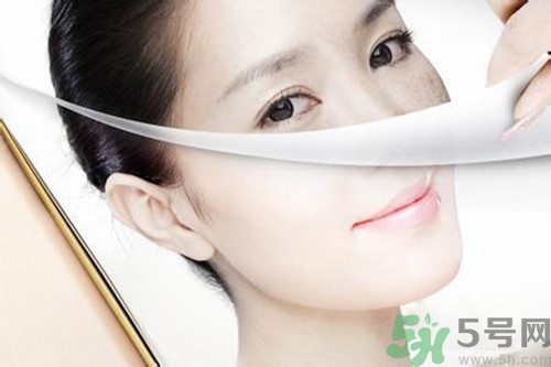 曬斑可以自己消退嗎？曬斑可以用激光去除嗎？