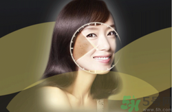 曬斑可以自己消退嗎？曬斑可以用激光去除嗎？