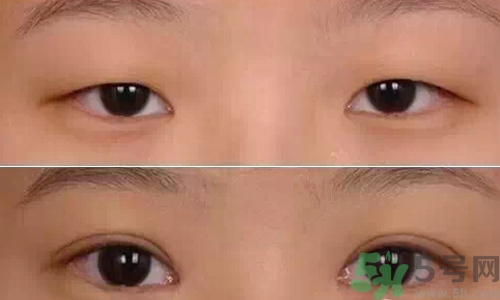 天生腫眼泡怎么消除？天生腫眼泡怎么辦？