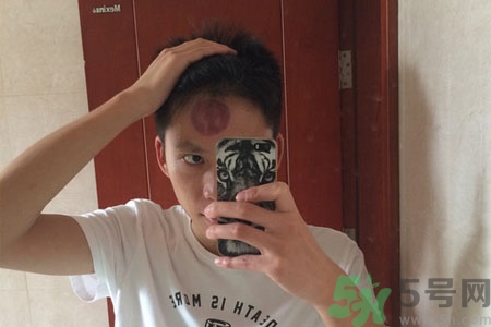 頭痛可以在額頭上拔火罐嗎？額頭上拔火罐有什么好處？