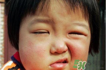 面癱能針灸嗎？針灸能治療面癱嗎？