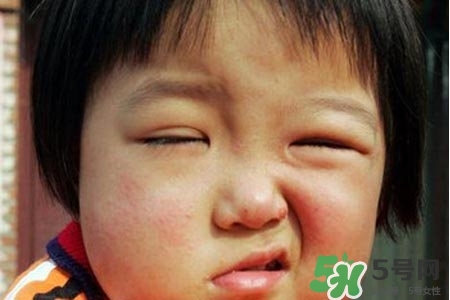 拔牙會導致面癱嗎?？拔牙為什么會導致面癱？