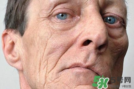 如何預防面癱復發？導致面癱的四大原因