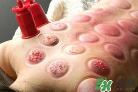 拔罐放血對身體好嗎？拔罐放血有什么好處？