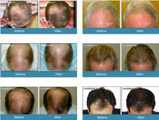 hairmax激光生發梳有用嗎?hairmax激光生發梳怎么樣?