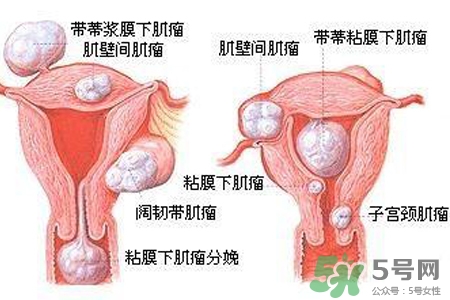 子宮小會影響生育嗎？子宮小會導致不孕嗎？