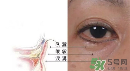 淚溝是怎么形成的?淚溝和眼袋的區別