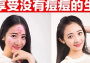 伊詩蘭頓祛痘怎么樣？伊詩蘭頓祛痘膏有用嗎？