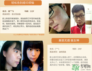 芷軒堂祛痘有效果嗎？芷軒堂祛痘印效果怎么樣？