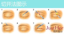 定點(diǎn)雙眼皮怎么做？定點(diǎn)雙眼皮需要拆線嗎？