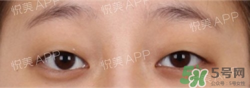 埋線雙眼皮多久恢復自然？埋線雙眼皮多久能恢復