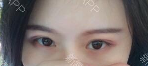 定點(diǎn)雙眼皮能保持多久？定點(diǎn)雙眼皮是永久的嗎？