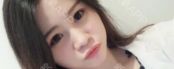 定點(diǎn)雙眼皮能保持多久？定點(diǎn)雙眼皮是永久的嗎？