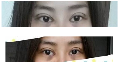 定點(diǎn)雙眼皮怎么做？定點(diǎn)雙眼皮需要拆線嗎？