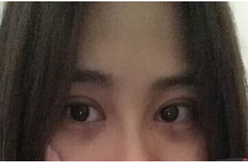 定點(diǎn)雙眼皮怎么做？定點(diǎn)雙眼皮需要拆線嗎？