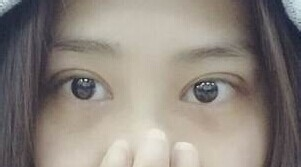 定點(diǎn)雙眼皮怎么做？定點(diǎn)雙眼皮需要拆線嗎？