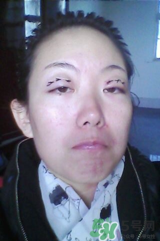 什么是定點雙眼皮？定點雙眼皮多少錢？