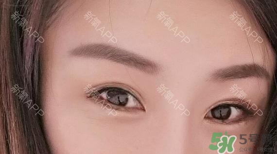 埋線雙眼皮能保持多久？埋線雙眼皮是永久嗎