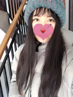 定點雙眼皮恢復過程圖_定點雙眼皮要多久恢復