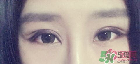 切開雙眼皮多久消腫？切開雙眼皮多久恢復？