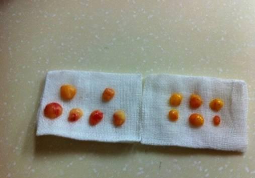 韓式三點雙眼皮是永久嗎？三點雙眼皮能保持多久？