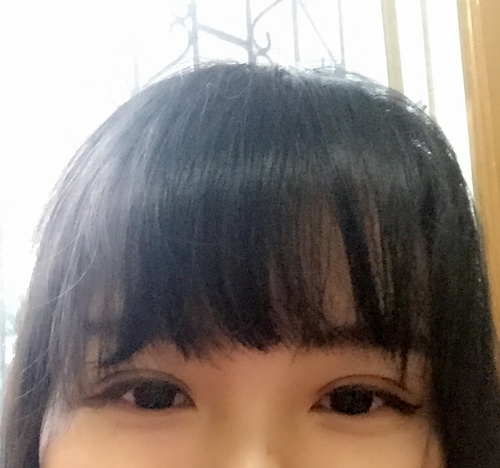 定點雙眼皮恢復過程圖_定點雙眼皮要多久恢復