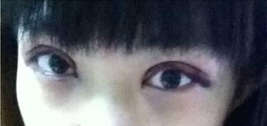 韓式三點雙眼皮是永久嗎？三點雙眼皮能保持多久？