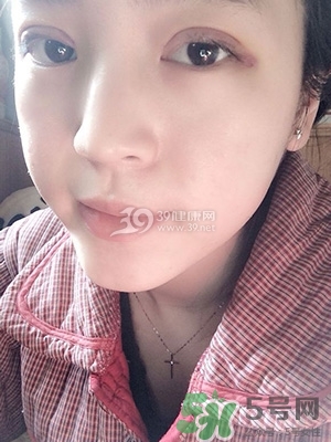 什么是定點雙眼皮？定點雙眼皮多少錢？