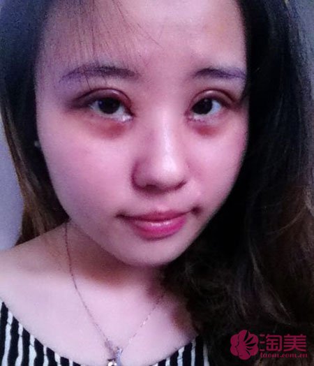 三點雙眼皮恢復過程圖_韓式三點雙眼皮多久恢復自然