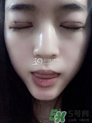 什么是定點雙眼皮？定點雙眼皮多少錢？